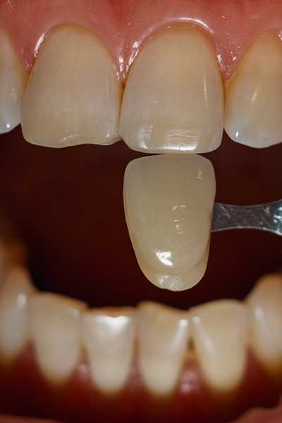 Close up of a veneer being placed over a tooth
