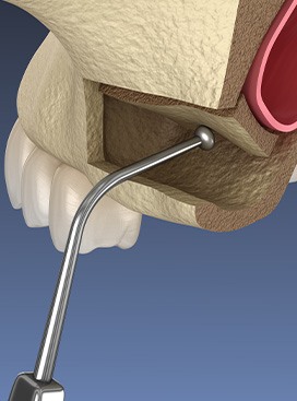 Digital illustration of a sinus lift