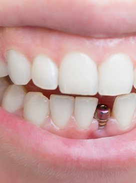 Closeup of a dental implant