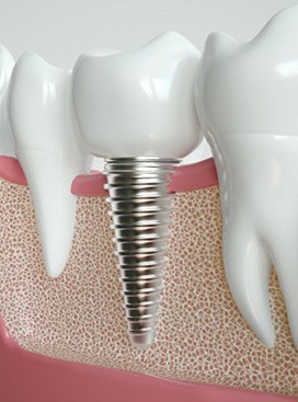 a 3D illustration of a dental implant in the jawbone