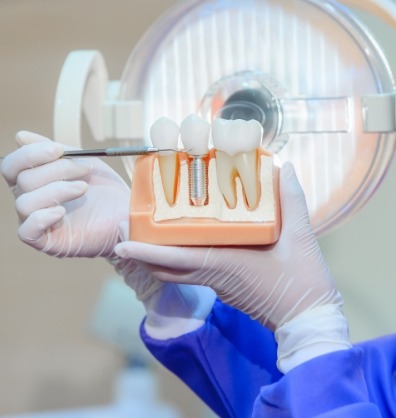 Dental professional holding a model of a dental implant