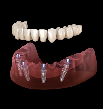 Illustration of full denture being placed onto four dental implants