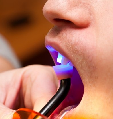 Dental patient having ultraviolet light shone on their upper front tooth