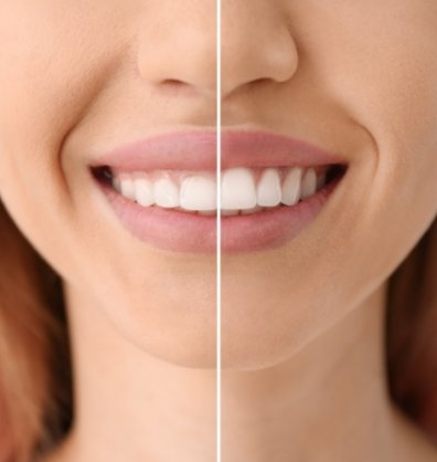 Close up of smile before and after gummy smile correction