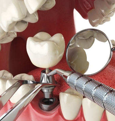 Illustrated dental implant with crown replacing a missing lower tooth