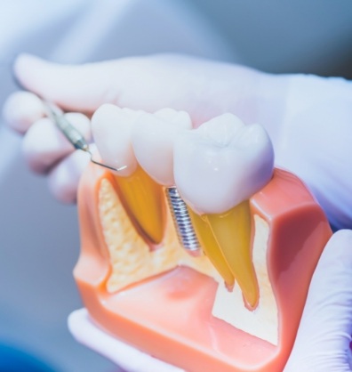 Dentist holding a model of a dental implant