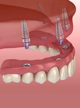 Illustrated full denture being fixed onto four dental implants