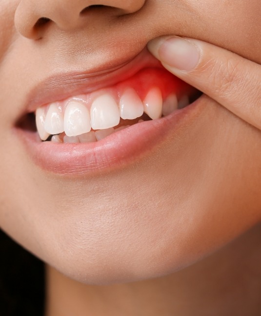 Person pointing to their red gums before gum disease treatment in San Jose