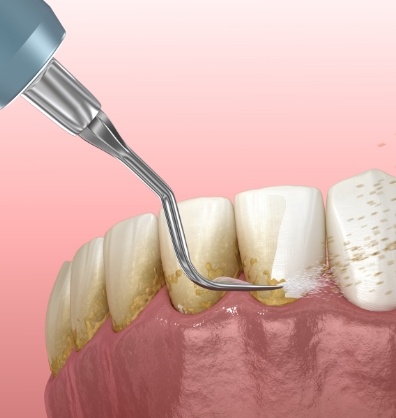 Illustrated dental scaler clearing plaque buildup from teeth and gums