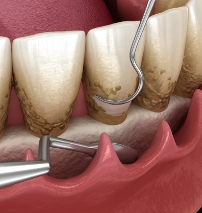 Illustrated dental instruments restoring diseased gum tissue