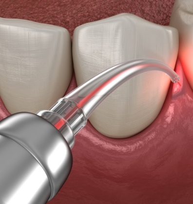 Illustrated dental laser treating gum disease