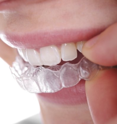 Close up of person placing an Invisalign aligner over their teeth