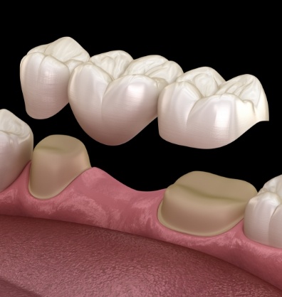 Illustrated dental bridge being placed to replace a missing tooth