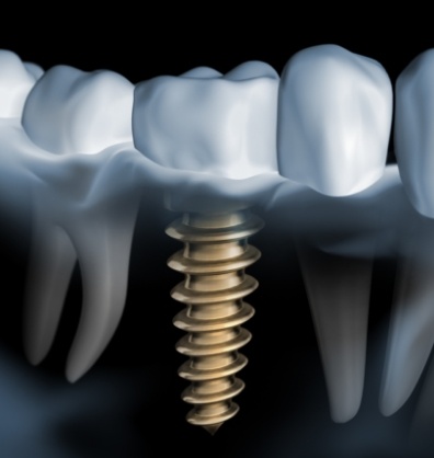 Illustrated dental implant replacing a missing lower tooth