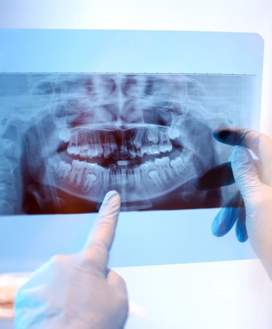 Dentist looking at x ray of teeth before oral surgery in San Jose