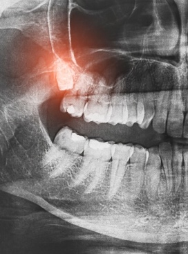 Close up of wisdom teeth highlighted on dental x ray