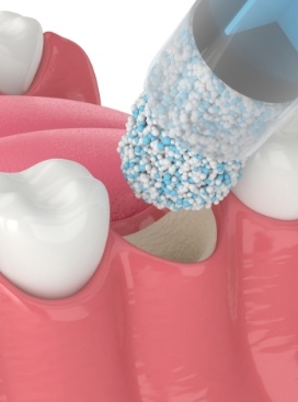 Illustration of bone grafting material being placed in socket after tooth extraction