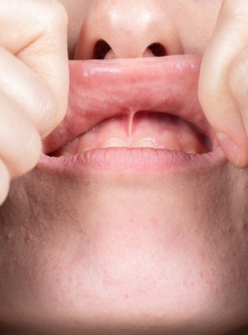 Close up of person pulling up their upper lip