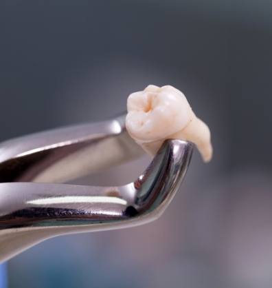 Dental forceps holding an extracted tooth