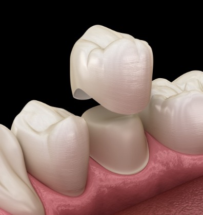 Illustrated dental crown being fitted over a tooth