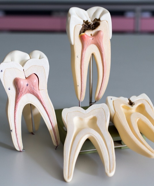 Models of decayed teeth that need root canal treatment in San Jose