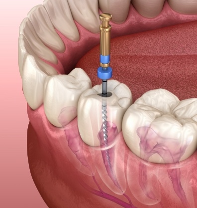 Illustrated dental instrument treating the inside of a tooth