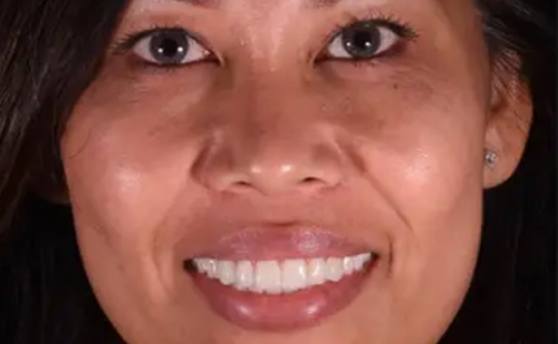 Woman smiling with white and restored teeth