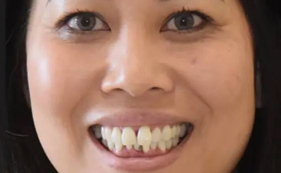 Woman smiling with a few damaged and discolored teeth