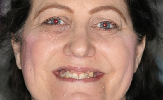 Close up of woman smiling with misaligned and discolored teeth before ALl on 4