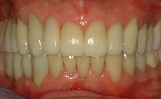 Close up of smile with new dental restorations