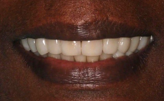 Close up of smile with aligned teeth after full mouth rehabilitation