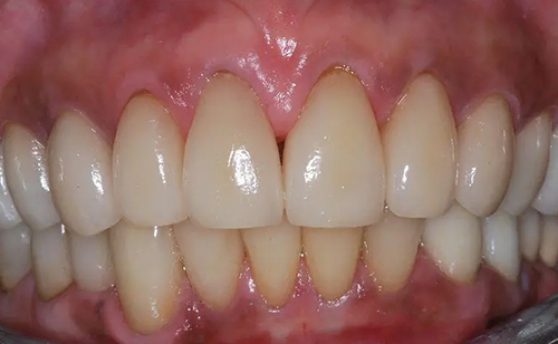 Close up of mouth after fixing gapped and discolored teeth