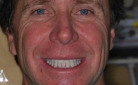 Man smiling with brighter teeth