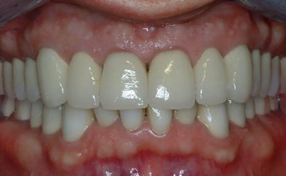 Close up of mouth with white restored teeth after full mouth rehabilitation