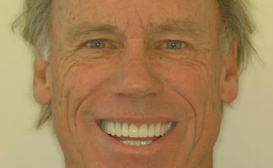 Senior man grinning with newly straightened teeth