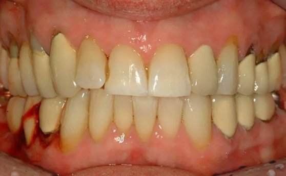 Close up of mouth with a few old dental crowns