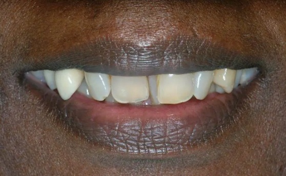 Close up of smile with overcrowded teeth