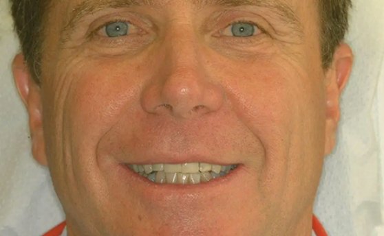 Man smiling with discolored teeth