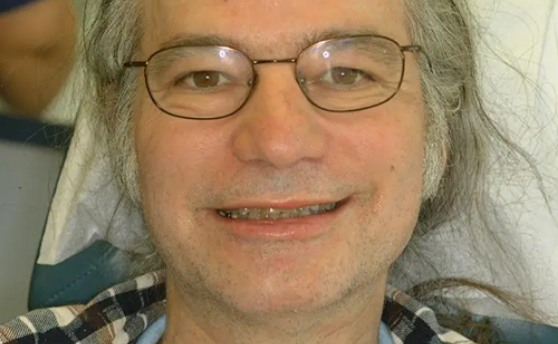 Man with long gray hair smiling with stained and damaged teeth