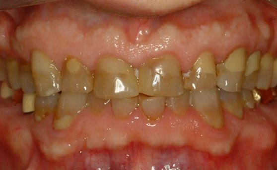 Close up of mouth with stained misshapen and damaged teeth