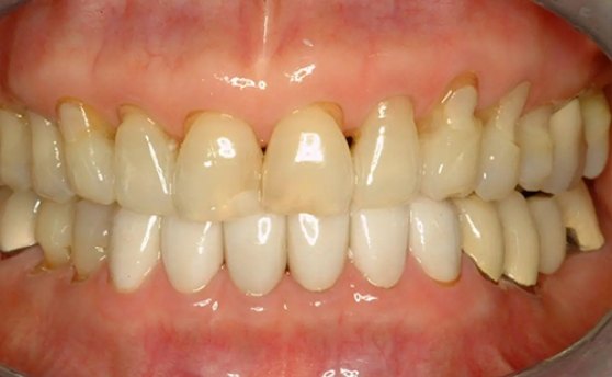 Close up of mouth with receding gums and a few stained teeth