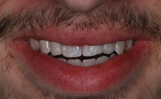 Smiling man with a full row of upper teeth