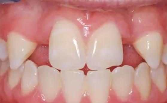 Upper arch of teeth with two missing teeth