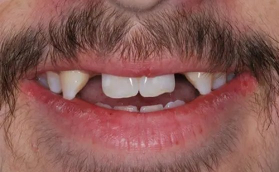 Smiling man missing two upper teeth