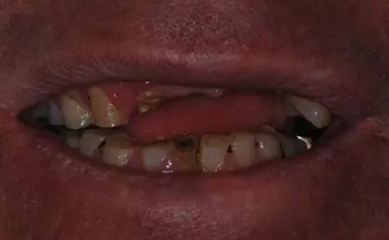 Mouth with multiple missing and damaged teeth