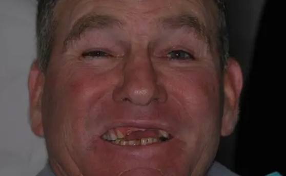 Man grinning with several missing teeth