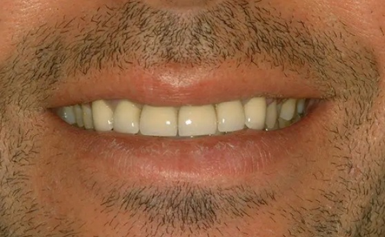 Close up of man smiling after correcting slightly uneven teeth