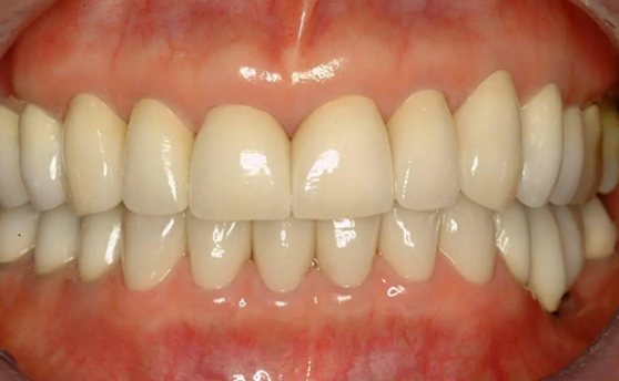 Mouth after fixing damaged teeth and receding gums