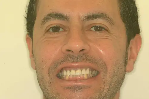 Man smiling before dental treatment