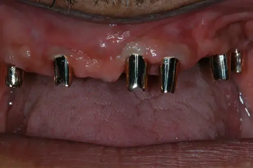 Mouth with several dental implant abutments visible from the gums